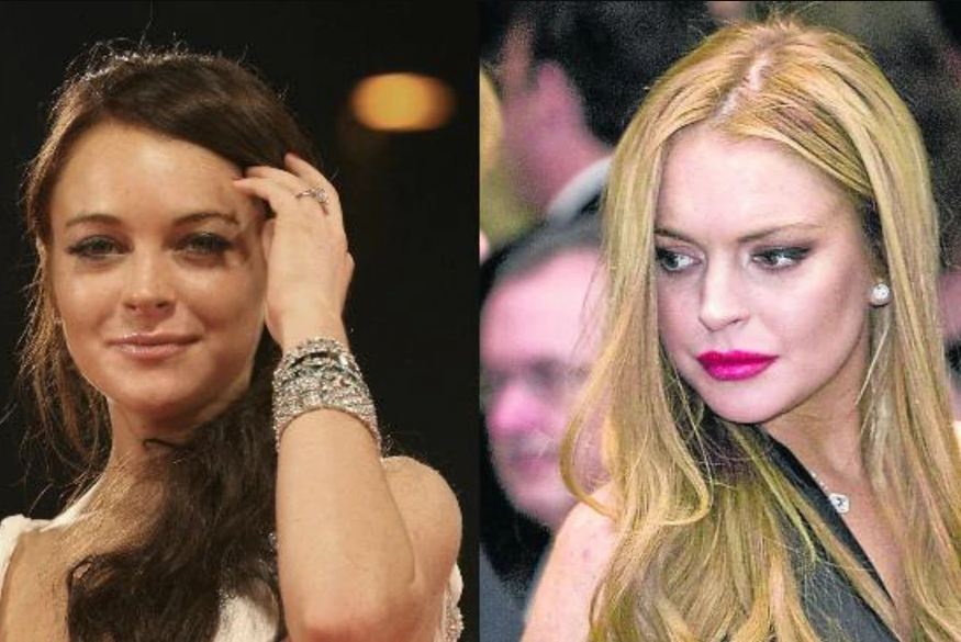 Lindsay Lohan cirugía plástica