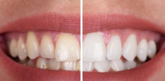 Blancorexia dientes