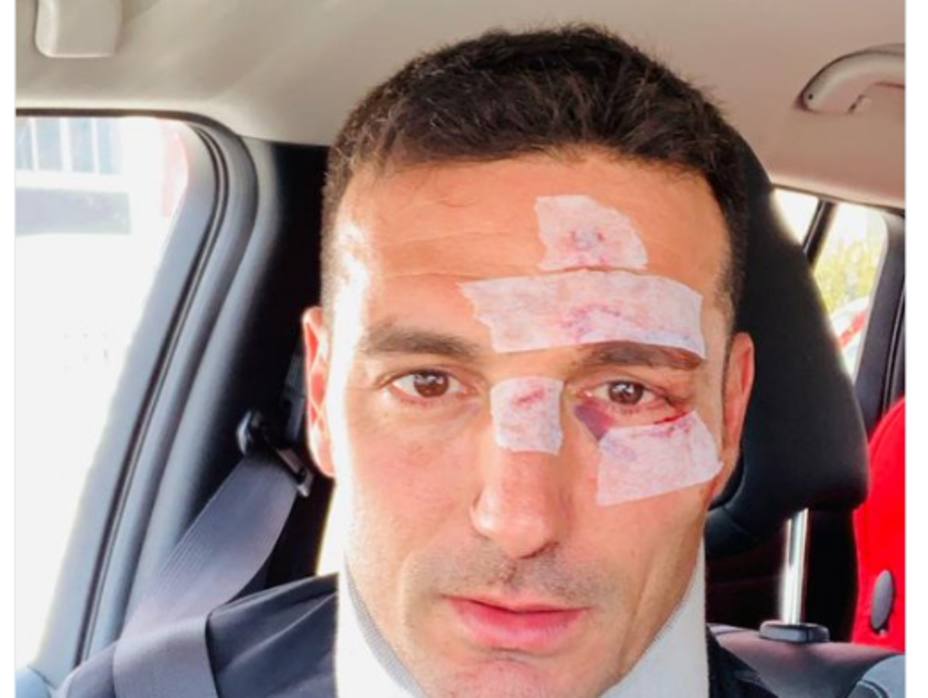 seleccionador-lionel-scaloni-resulto-herido-tras-ser-atropellado_278408.jpg