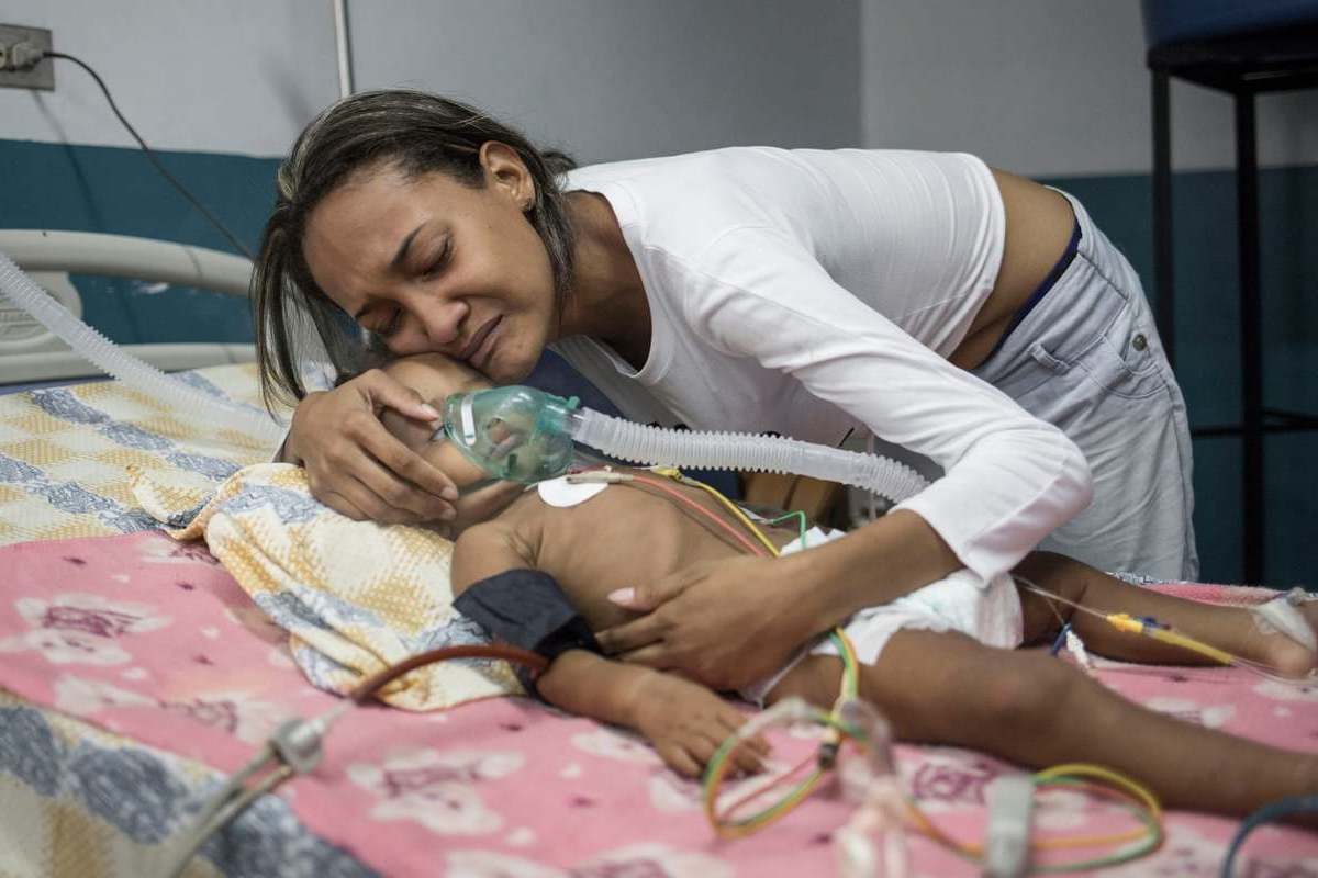 Desnutrición infantil severa en Venezuela (1)