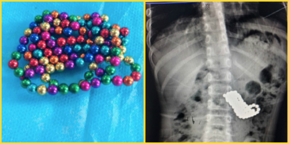 Un niño de cinco años se traga 123 bolitas magnéticas y tiene que ser  operado de urgencia: los imanes no son para niños pequeños