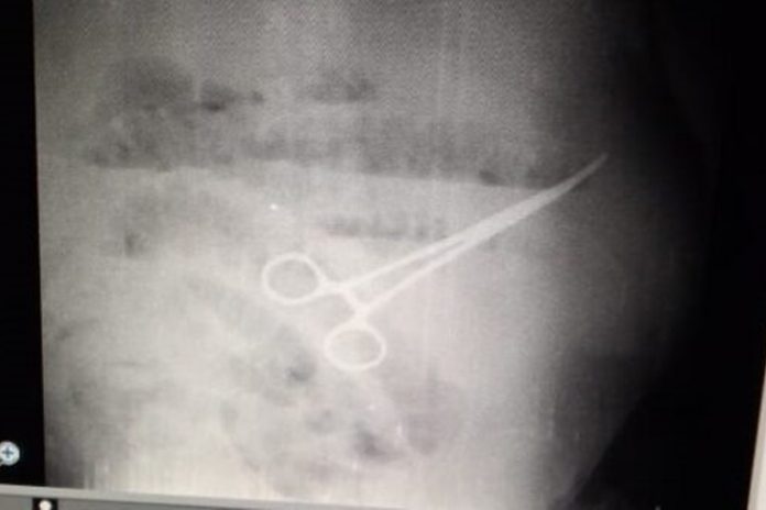 Hombre murió luego de que cirujano dejó unas tijeras en su estómago