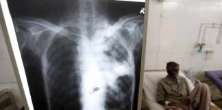 tuberculosis Venezuela