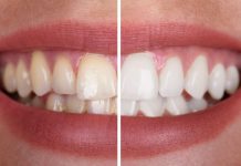 Blancorexia dientes