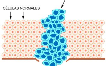 El estrés prolongado podría contribuir de manera directa a la aparición y la progresión del cáncer