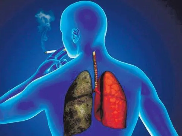 cancer de pulmon