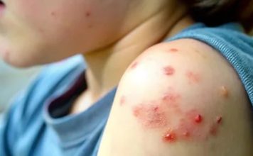 Brote de sarampión en EE UU: Texas lidera lista con 683 contagios y 2 muertes Brote de sarampión en EE UU: Texas lidera lista con 683 contagios y 2 muertes